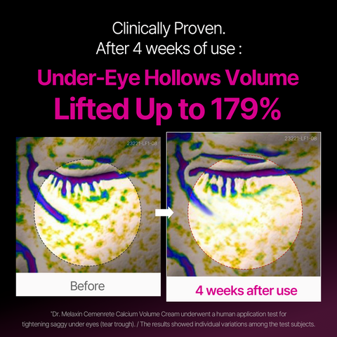 Leviri Calcium Ampoule