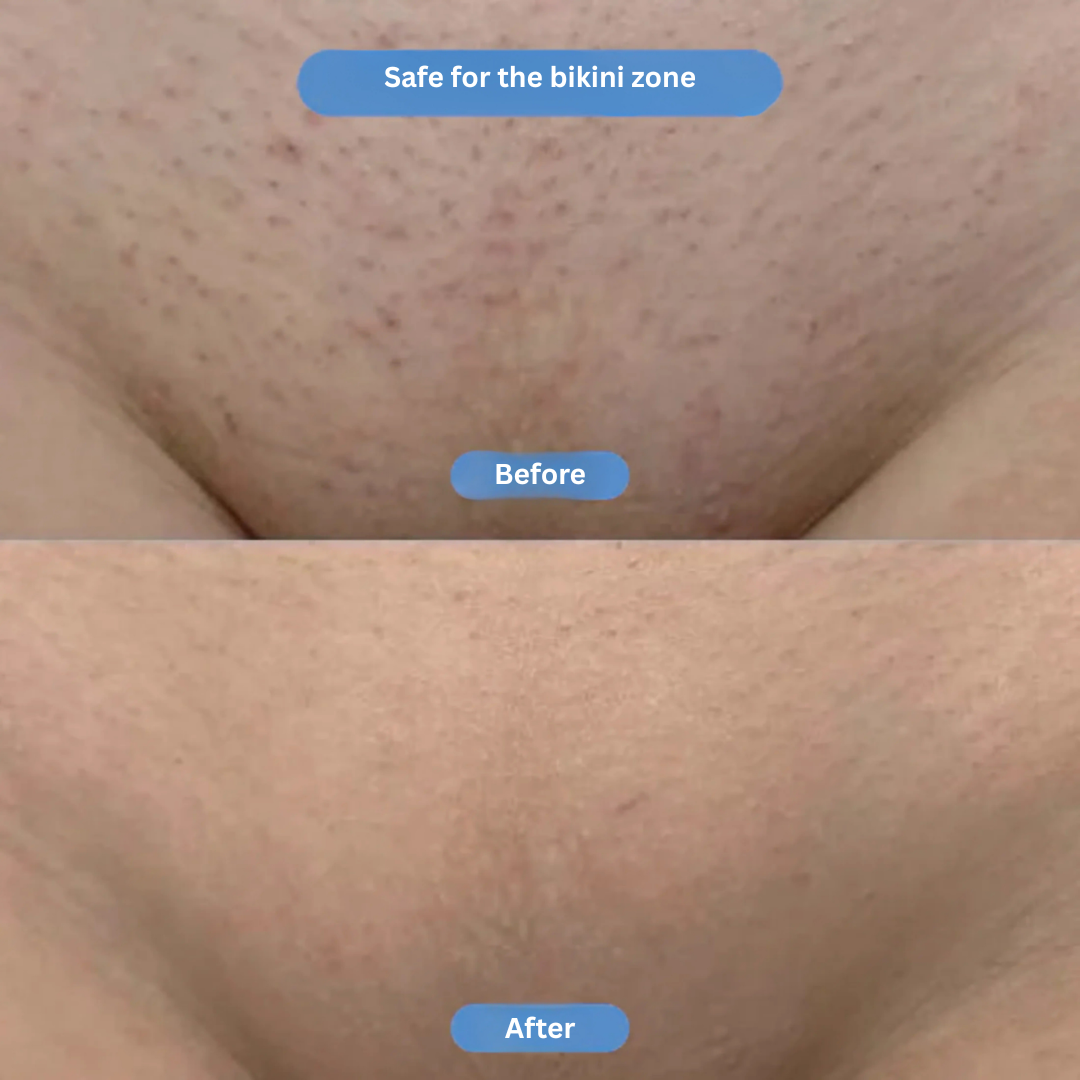 Leviri Smoothing Solution Ingrown Hair Treatment